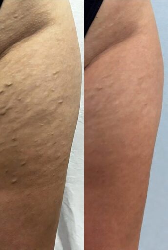 Cellulite-Gone-Reviews-before-after